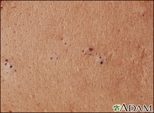 Blackheads (comedones)