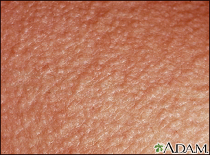 baby dry skin rash