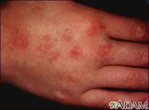 Telangiectasia Information