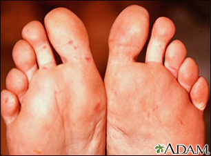 Hand-foot-mouth disease Information