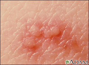 herpes zoster symptoms