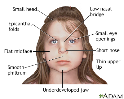 fetal alcohol syndrome eyes far apart