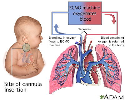 ecmo heart lung machine