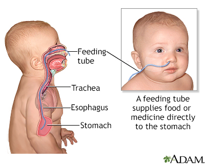 Feeding tube - infants Information