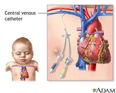 Central venous catheter - Illustration Thumbnail
              