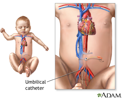 Umbilical catheter - Illustration Thumbnail
                      