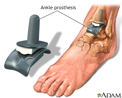 Ankle Replacement — Ankle Arthritis