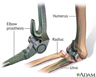 Elbow prosthesis - Illustration Thumbnail
              