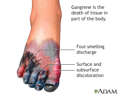 Gangrene