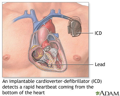 Défibrillateur cardioverteur implantable
