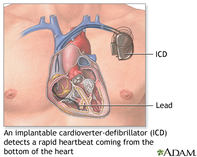 Implantable cardioverter-defibrillator - Illustration Thumbnail
                      