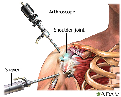 Shoulder arthroscopy - Illustration Thumbnail
                      