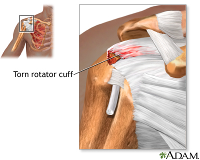 Indications - Torn rotator cuff