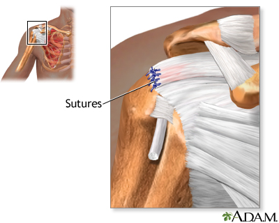 Mini-Open Rotator Cuff Repair