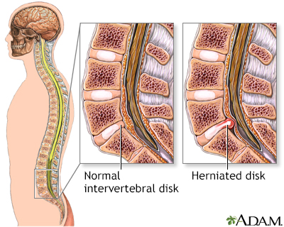 Microdiskectomy - series