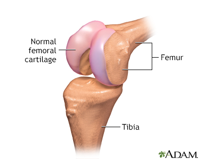 Partial knee replacement - series - Presentation Thumbnail              