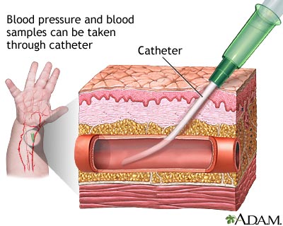 Peripheral arterial line - infants Information