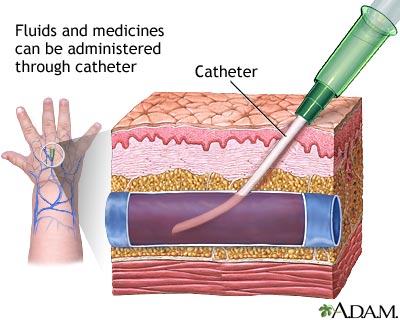 Peripheral intravenous line - Illustration Thumbnail
              