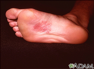 Common Rashes That Can Cause Foot Pain and Irritation - Walkrite Foot Clinic