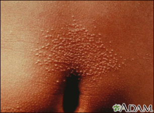 mayo clinic lichen planus