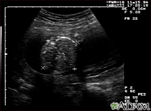 Ultrasound, normal fetus - abdomen measurements - Illustration Thumbnail              