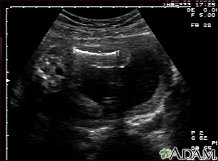 Ultrasound, normal fetus - femur measurement - Illustration Thumbnail              