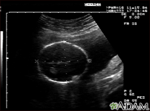 Ultrasound, normal fetus - head measurements - Illustration Thumbnail
              