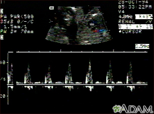 Ultrasound, ventricular septal defect - heartbeat - Illustration Thumbnail
                      