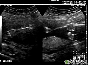 20 weeks pregnant ultrasound abnormalities