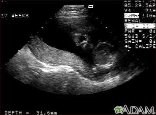 anencephaly ultrasound 9 weeks