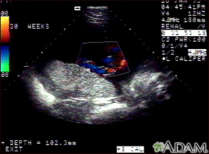 Ultrasound, color - normal umbilical cord - Illustration Thumbnail
                      