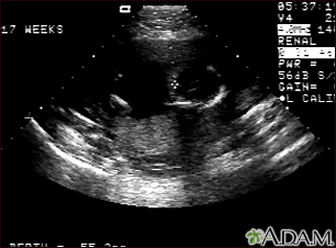 Ultrasound, normal fetus - ventricles of brain - Illustration Thumbnail
              