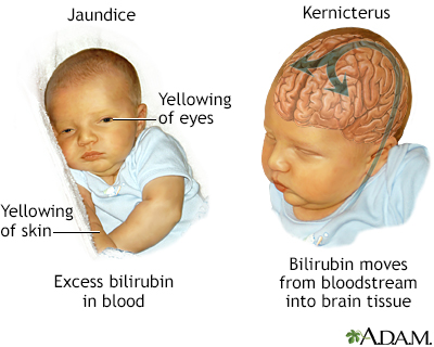 Bilirubin encephalopathy Information | Mount Sinai - New York