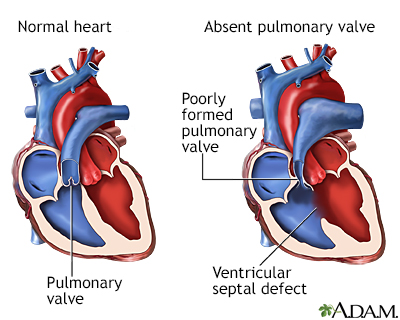 Absent pulmonary valve Information | Mount Sinai - New York