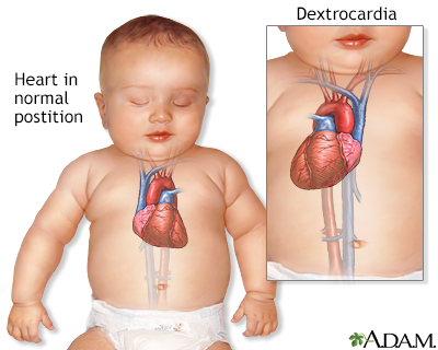 Dextrocardie