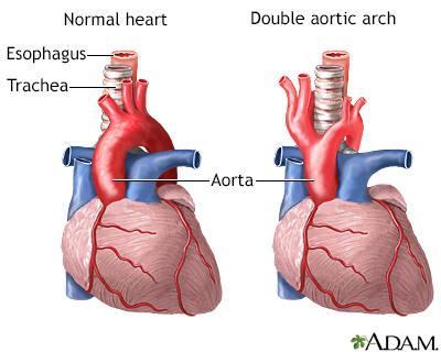 Arc aortique double