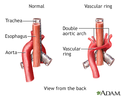 aortic ring surgery