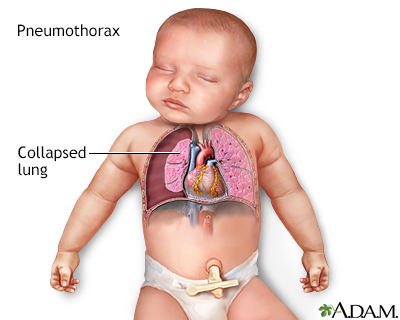 Pneumothorax - Illustration Thumbnail              