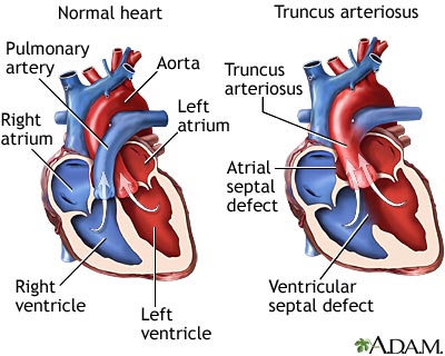 Truncus arteriosus - Illustration Thumbnail
              