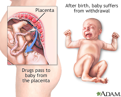 Neonatal abstinence syndrome - Illustration Thumbnail
                      