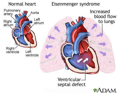 Syndrome d'Eisenmenger (ou complexe)