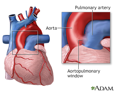 Fenêtre aortopulmonaire