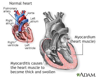 Myocarditis - Illustration Thumbnail
              