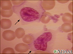 Mononucleosis - photomicrograph of cell - Illustration Thumbnail
              