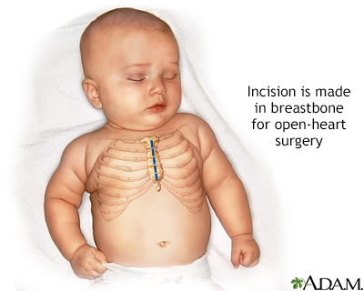 Infant open heart surgery - Illustration Thumbnail
                      