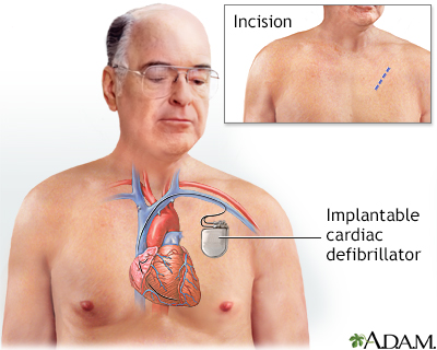 Implantable cardiac defibrillator