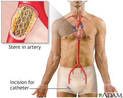 HIE Multimedia - Angioplasty and stent placement - peripheral arteries -  discharge