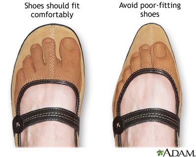 Relieving Foot Pain from Tight Shoes: Expert Insights & Tips