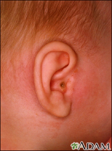 mastoiditis in adults treatment