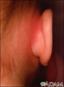 mastoiditis in adults treatment